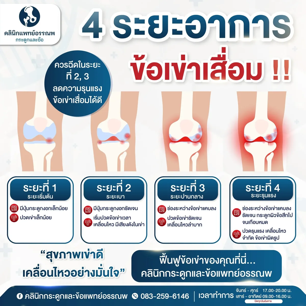 อินโฟกราฟิกแสดง 4 ระยะของข้อเข่าเสื่อม